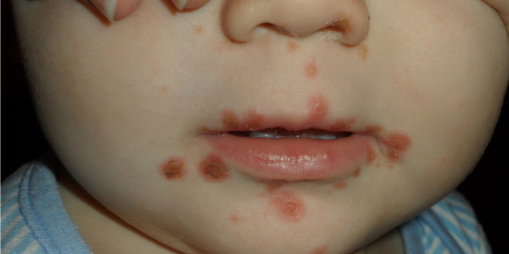 Un infant afectat pel mà-boca-peus a la cara.
